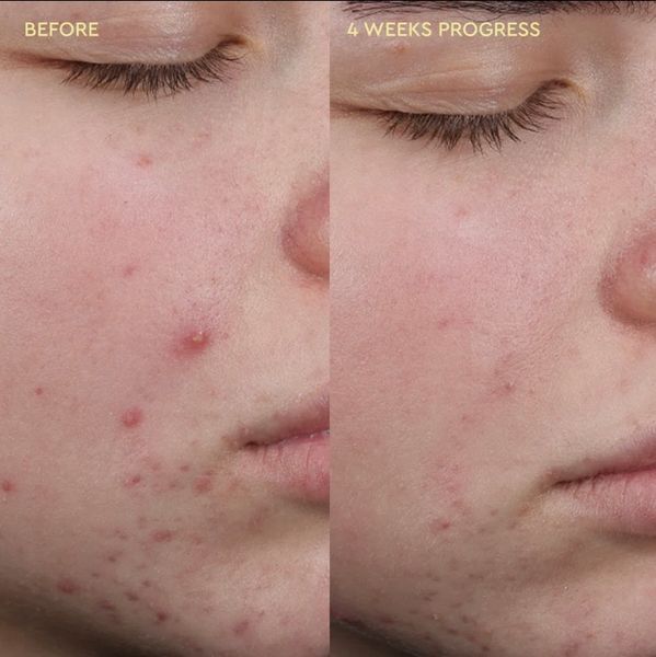 Очисний засіб проти прищів BYOMA Blemish Clearing Cleanser 175 ml 145 фото